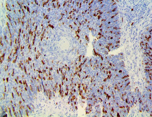 IHC of Cyclin B1 on an FFPE Cervical Cancer Tissue